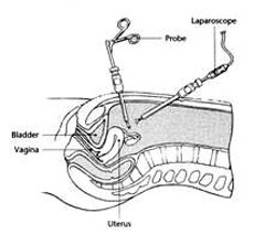 Bluegrass Fertility Center - Lexington, KY Laparoscopy 