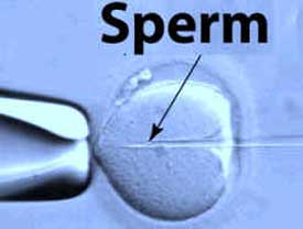 Male Factor including ICSI at Bluegrass Fertility Center.